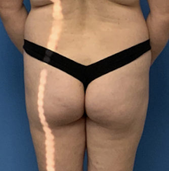 Brazilian-Butt-Lift-with-Liposuction | Before Liposuction
